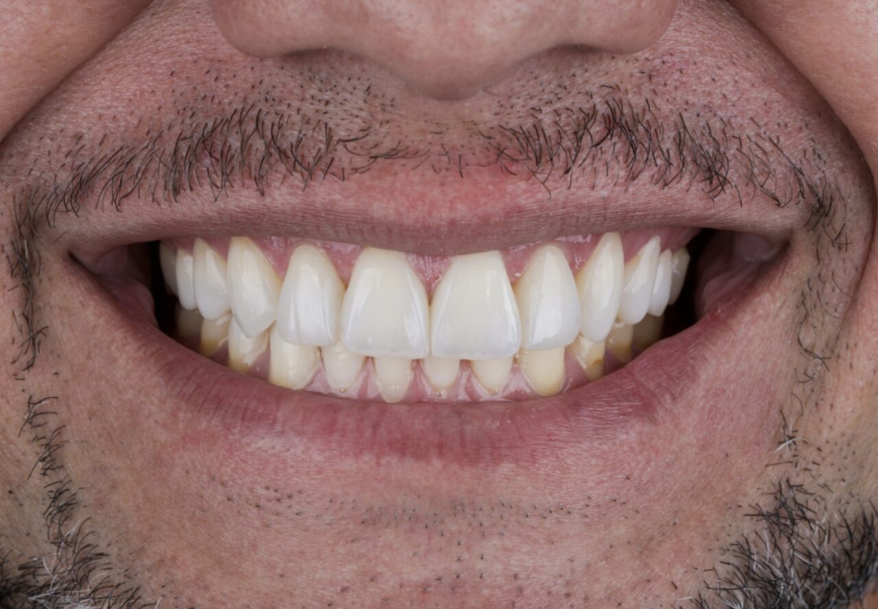 Procuro Parceria para Lentes / Facetas em resina