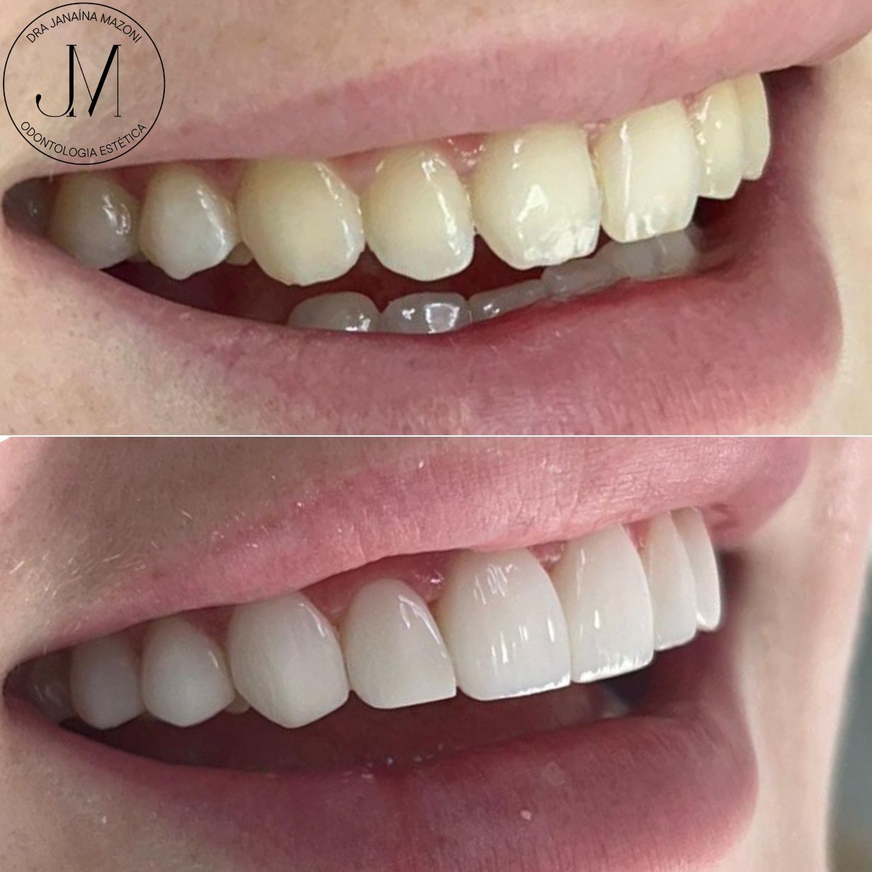 DENTISTA FREELANCER | FACETAS EM RESINA COMPOSTA